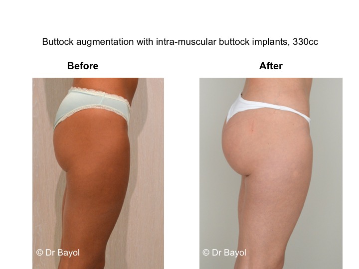 Buttocks surgery: buttock lift, body lift, buttock implants and