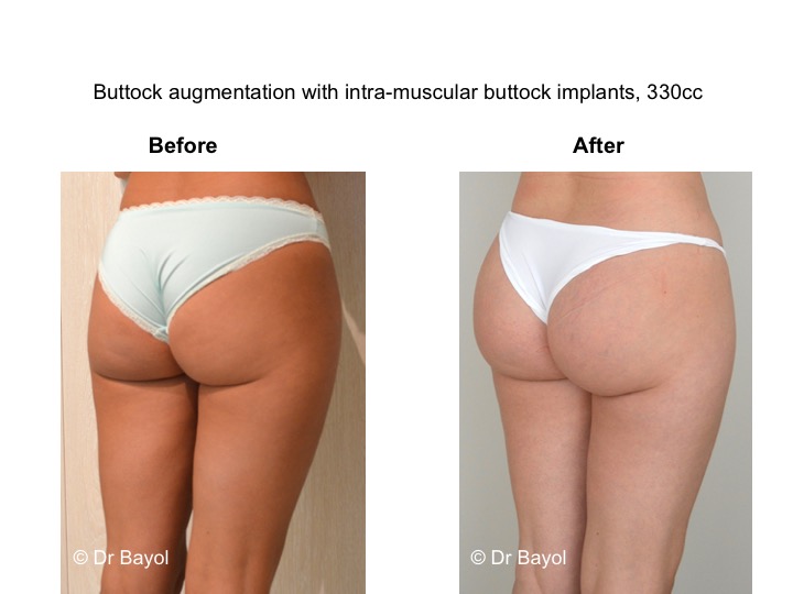 protheses fesses lausanne - dr bayol