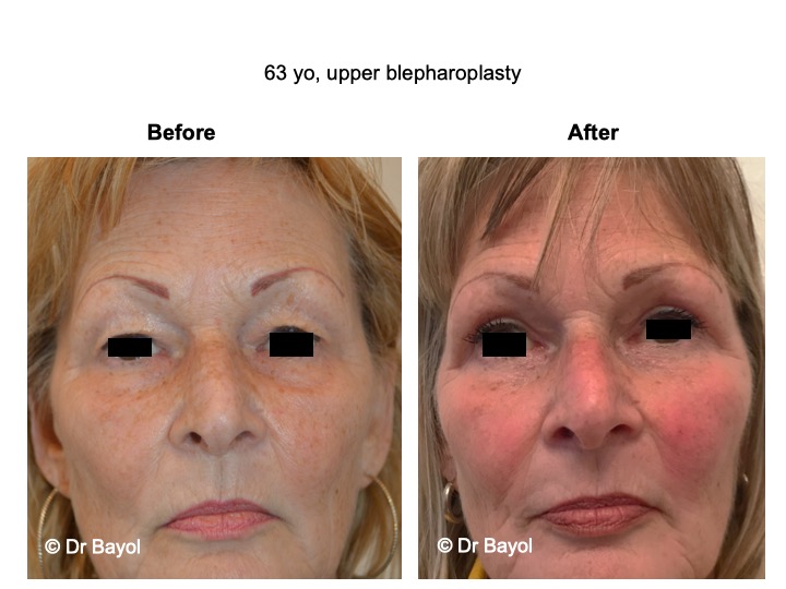 bon chirurgien blépharoplastie