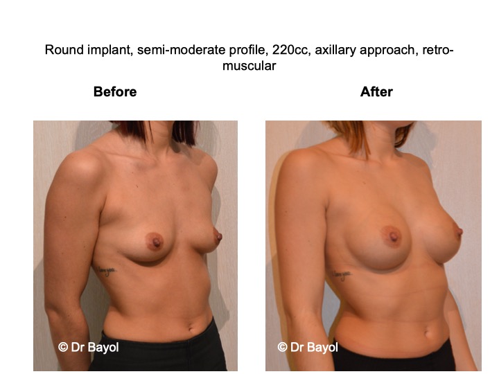 breast augmentation