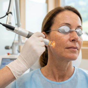 Comment le laser efface les taches pigmentaires sur le visage ?